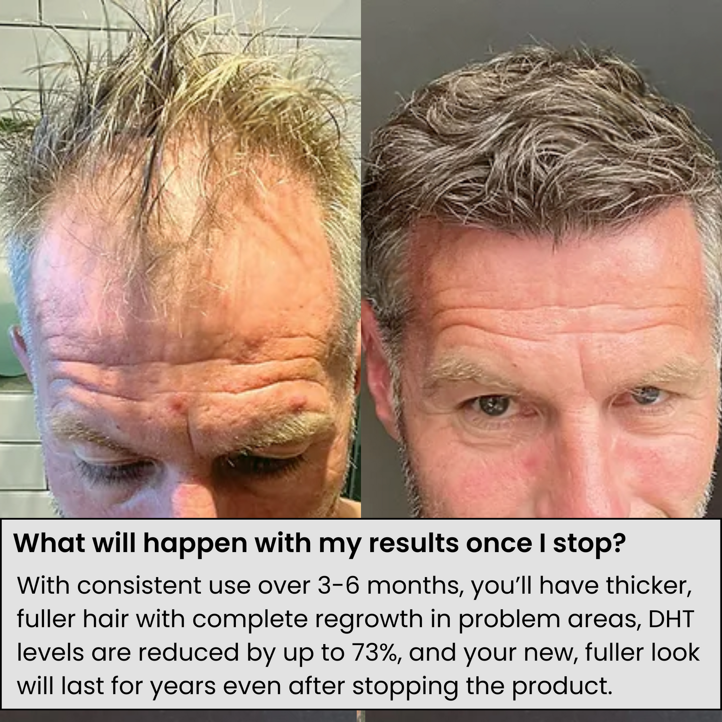 AlphaRoots™ Hair Regrowth System